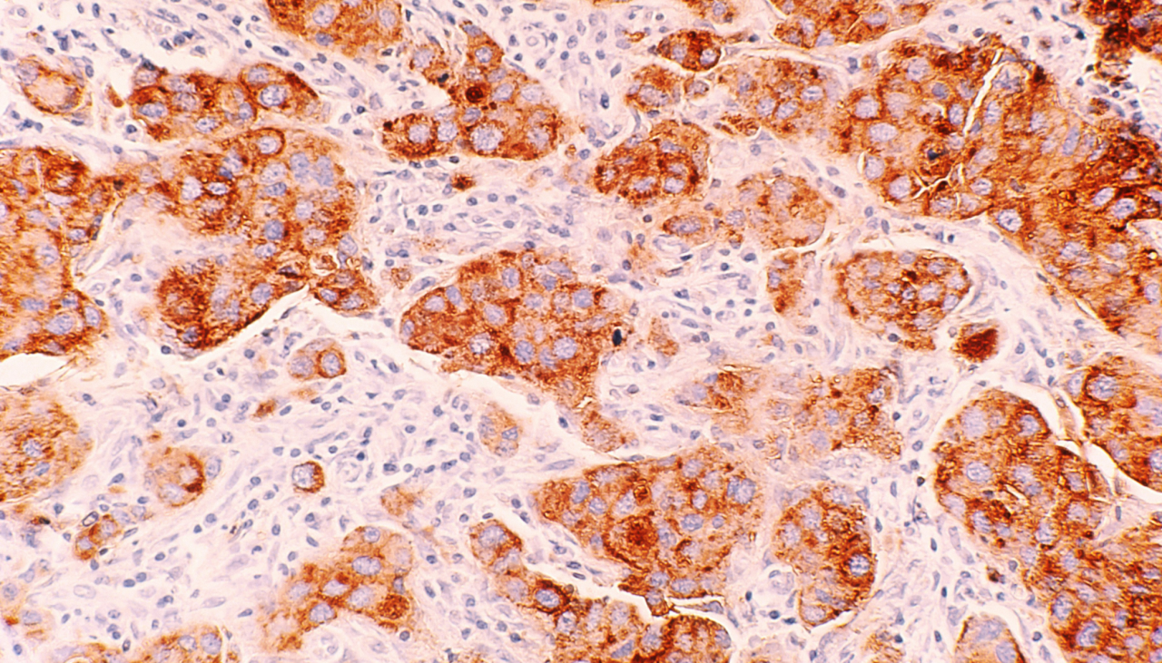 Allelica licenses University of Cambridge BOADICEA Model to deliver ...